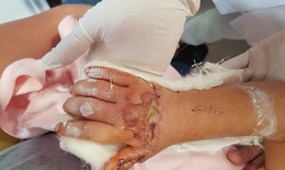6 giờ phẫu thuật vi phẫu nối bàn tay gần đứt rời cho bé gái 3 tuổi