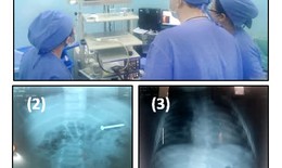 C&#249;ng l&#250;c cấp cứu th&#224;nh c&#244;ng 2 bệnh nhi nuốt  phải đinh