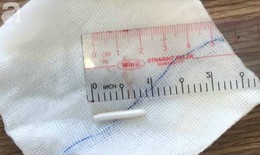 Cứu sống bệnh nhi 18 tháng bị chiếc nĩa đâm xuyên họng