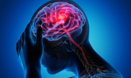 Tai biến mạch máu não: Cách phòng tránh và phục hồi chức năng