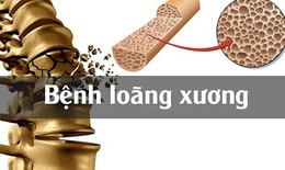 Những chất cần bổ sung để tránh nguy cơ loãng xương, gãy xương