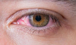 Ph&#242;ng v&#224; điều trị đau mắt đỏ sau mưa lũ