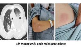 Cứu sống nữ bệnh nh&#226;n nhiễm vi khuẩn Whitmore g&#226;y &#225;p xe nặng, suy kiệt