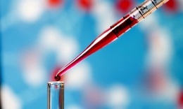 C&#225;ch nhận biết trẻ sơ sinh bị bệnh Lupus