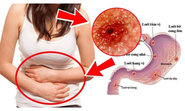 Đột ph&#225; mới cho người bệnh dạ d&#224;y