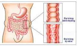 5 b&#224;i thuốc nam điều trị vi&#234;m đại tr&#224;ng mạn t&#237;nh