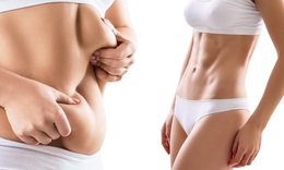 Thẩm mỹ viện du k&#253;: H&#250;t mỡ thẩm mỹ, sự thật v&#224; ngộ nhận