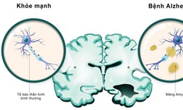 Thuốc trị đa xơ cứng c&#243; thể l&#224;m giảm chứng mất tr&#237; nhớ của bệnh Alzheimer