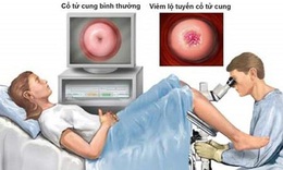 C&#243; n&#234;n đốt diệt tuyến khi mắc vi&#234;m lộ tuyến cổ tử cung?