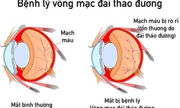 Bệnh v&#245;ng mạc đ&#225;i th&#225;o đường - Những điều cần biết