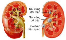 Đ&#244;ng y trị bệnh sỏi tiết niệu