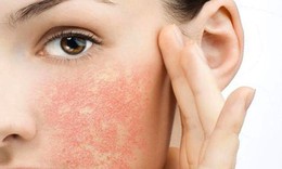 Cách nhận biết và xử trí dị ứng mỹ phẩm cho chị em