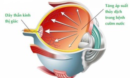 6 lưu &#253; trong sinh hoạt d&#224;nh cho người mắc bệnh Glaucoma 