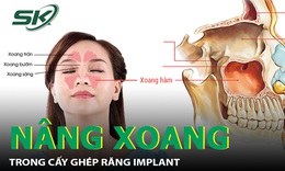 N&#226;ng xoang h&#224;m trong cấy gh&#233;p răng Implant