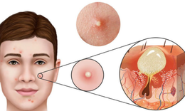 Mụn trứng c&#225;: Nguy&#234;n nh&#226;n v&#224; c&#225;ch kiểm so&#225;t mụn hiệu quả