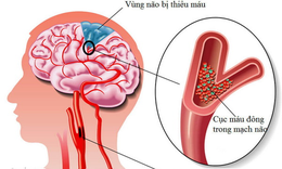 3 dấu hiệu sớm cảnh b&#225;o đột quỵ trước cả FAST
