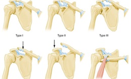 Kh&#244;ng n&#234;n chủ quan khi bị sai khớp c&#249;ng đ&#242;n