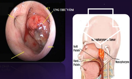 U xơ mạch v&#242;m mũi họng: Nguy&#234;n nh&#226;n, chẩn đo&#225;n v&#224; điều trị