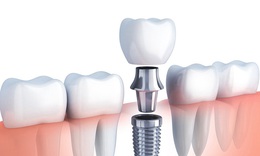 Những yếu tố quyết định an to&#224;n trong Trồng răng Implant