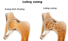 Bổ sung canxi v&#224; vitamin D3 lứa tuổi n&#224;o l&#224; tốt nhất để ph&#242;ng lo&#227;ng xương?