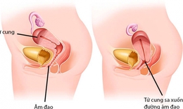 Sa tử cung v&#224; c&#225;ch hỗ trợ phục hồi bằng Đ&#244;ng y