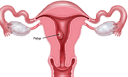 Ra huyết sau m&#227;n kinh – Cẩn thận bệnh nguy hiểm!