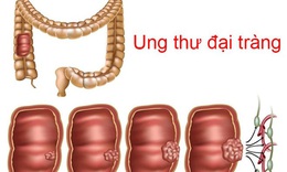 C&#225;c yếu tố nguy cơ của ung thư đại trực tr&#224;ng bạn cần biết