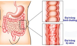 Ph&#242;ng v&#224; trị vi&#234;m đại tr&#224;ng co thắt