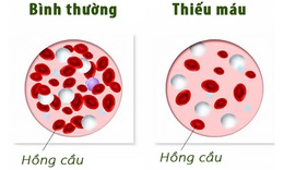 Thuốc roxadustat hiệu quả v&#224; an to&#224;n trong điều trị thiếu m&#225;u ở bệnh thận mạn t&#237;nh