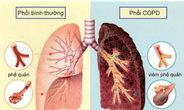 
Người bệnh phổi tắc nghẽn mạn t&#237;nh cần theo d&#245;i thế n&#224;o sau ti&#234;m vaccine COVID-19?