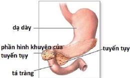 Tắc tá tràng ở trẻ sơ sinh - Mẹ cần biết để phát hiện sớm