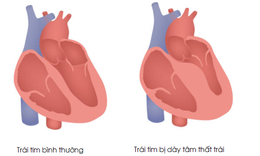 D&#224;y thất tr&#225;i - Căn bệnh nguy hiểm thường gặp ở người tăng huyết &#225;p