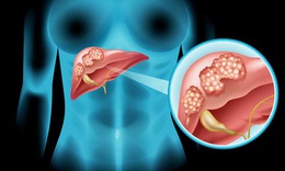 Vi&#234;m gan virus B v&#224; dự ph&#242;ng ung thư gan
