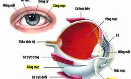 Đỏ v&#224; đau nhức mắt dữ dội - Cẩn thận bị vi&#234;m củng mạc