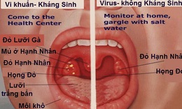 Vi&#234;m họng, khi n&#224;o cần d&#249;ng kh&#225;ng sinh? 