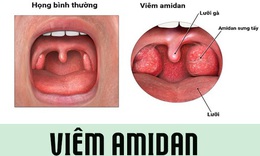 Một số m&#243;n ăn b&#224;i thuốc tốt cho người bị vi&#234;m amidan