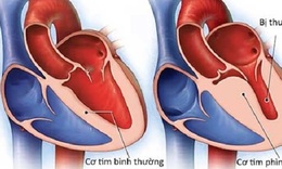 Viêm cơ tim sau tiêm vaccine COVID-19 có đáng ngại?