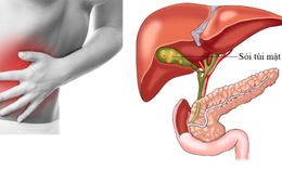 C&#225;c biến chứng nguy hiểm của sỏi mật