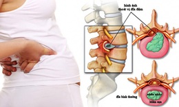 Tho&#225;t vị đĩa đệm cột sống: C&#225;ch điều trị v&#224; ph&#242;ng tr&#225;nh