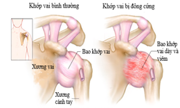 5 b&#224;i tập hỗ trợ điều trị vi&#234;m quanh khớp vai