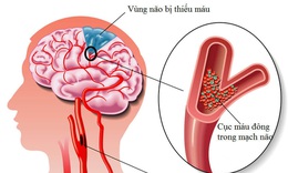 Đ&#244;ng y điều trị thiểu năng tuần ho&#224;n n&#227;o