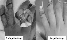 Anh sơ ý trong lúc nấu cơm khiến 2 ngón tay của em trai 7 tuổi gần đứt rời