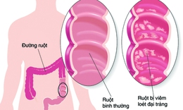 Liệu ph&#225;p kết hợp thuốc c&#243; thể gi&#250;p chữa vi&#234;m lo&#233;t đại tr&#224;ng hiệu quả