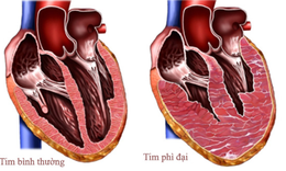 FDA chấp nhận ứng dụng thuốc mới trong bệnh cơ tim ph&#236; đại tắc nghẽn