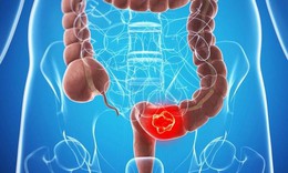 Phương ph&#225;p điều trị ung thư đại trực tr&#224;ng phổ biến