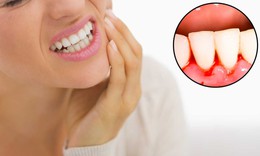 6 b&#224;i thuốc l&#224;m nước s&#250;c miệng chống chảy m&#225;u ch&#226;n răng