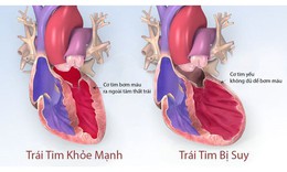 Thuốc gi&#250;p cải thiện triệu chứng ở bệnh nh&#226;n suy tim