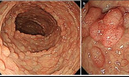 Hội chứng đa polyp gia đ&#236;nh v&#224; mối li&#234;n quan với ung thư đại trực tr&#224;ng