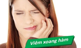 Vi&#234;m xoang h&#224;m do răng&#160;c&#243; biểu hiện như thế n&#224;o?