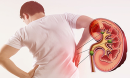 5 phương ph&#225;p lấy sỏi thận ra khỏi cơ thể hiệu quả